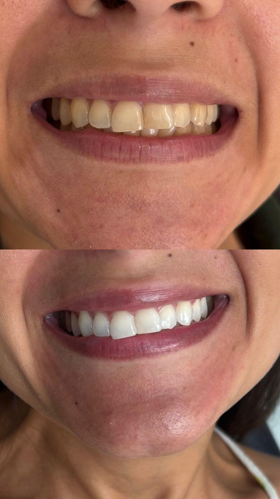 Antes e depois de prótese e lente de contato dental